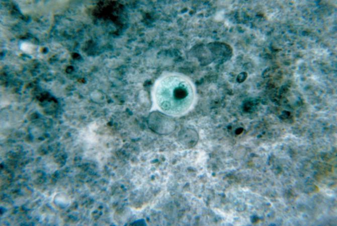 Entamoeba Histolytica