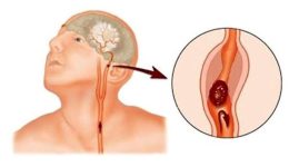 İnme Nedir, Neden Olur Riskli Kişiler ve Tedavi Yolları