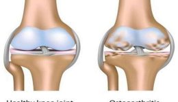 Osteoartrit Neden Olur, Tehlikeli Midir? Tanısı ve Tedavisi Mümkün Müdür?