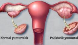 Polikistik Over Sendromu Sebepleri ve Çeşitleri
