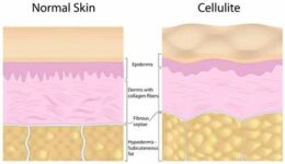 Selülit Nedenleri ve Alınabilecek Önlemler